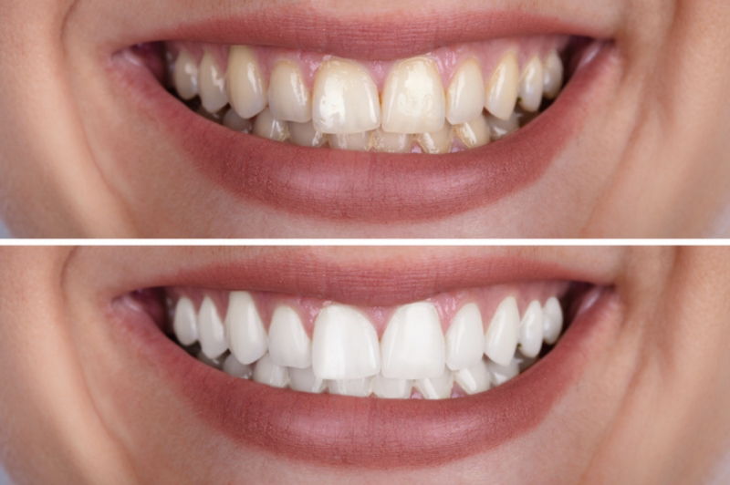 Bạn có thể tẩy trắng răng sau khi niềng răng?