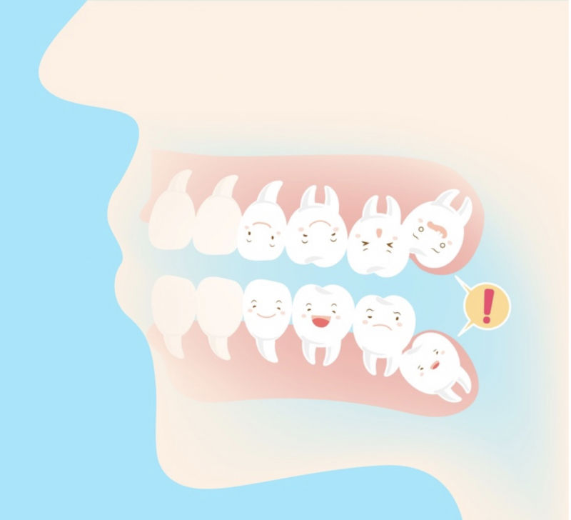 Có cần phải nhổ răng khôn khi niềng răng?