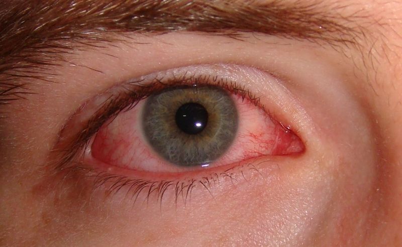 Đau mắt đỏ hay còn gọi là viêm kết mạc