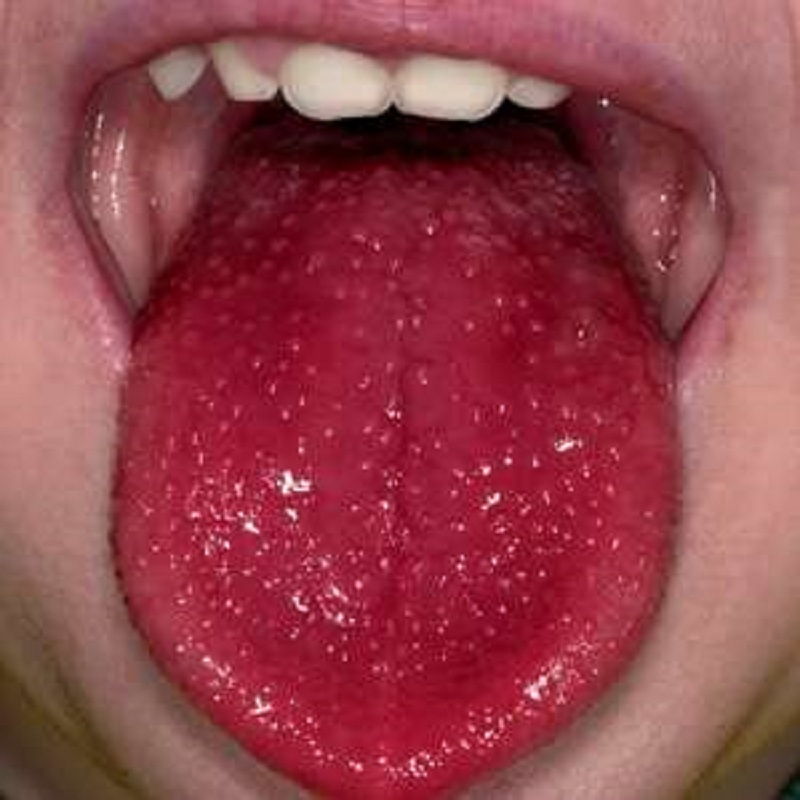 Lưỡi có màu đỏ, kèm theo xuất hiện nhiều đốm trắng (trông như quả dâu tây)