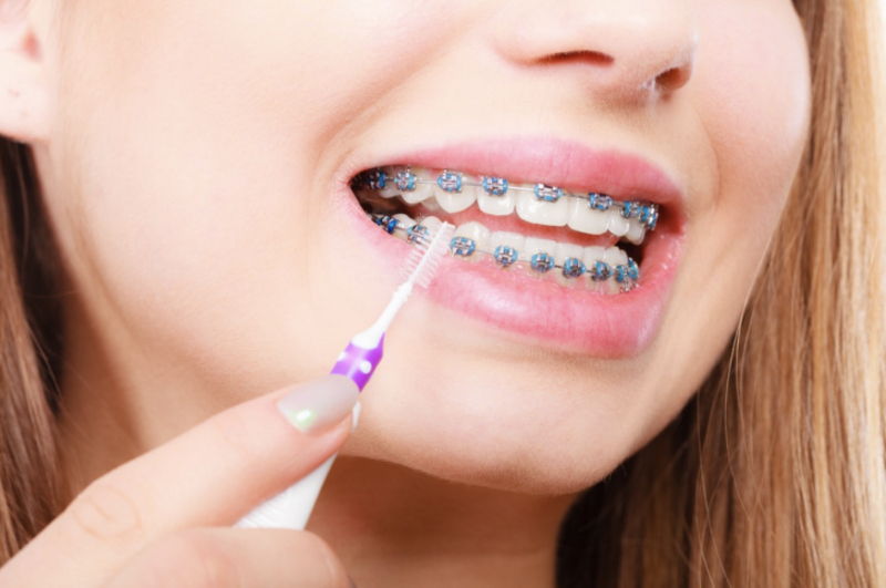 Niềng răng có làm hỏng men răng và gây sâu răng?