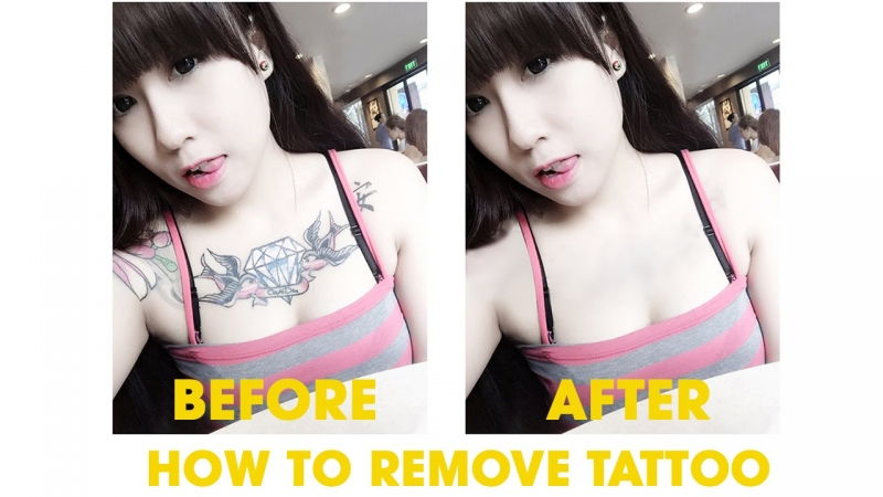 Remove Tattoo