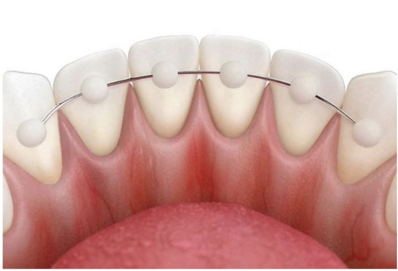Sau khi tháo mắc cài, răng có bị dịch chuyển trở lại không?