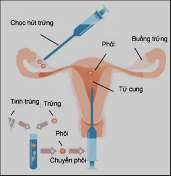 Thụ tinh ống nghiệm (IVF)