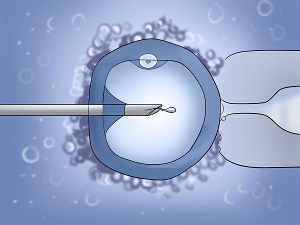 Tiêm tinh trùng vào bào tương trứng (ICSI)