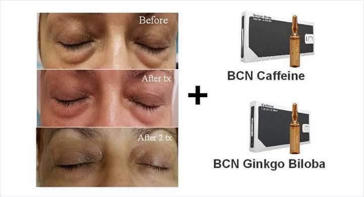 Tiêm trị thâm quầng mắt BCN INSTITUTES Tây Ban Nha