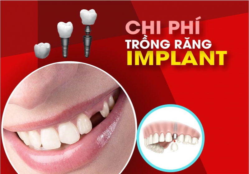 Bảng giá trồng răng Implant phù hợp với người mất răng