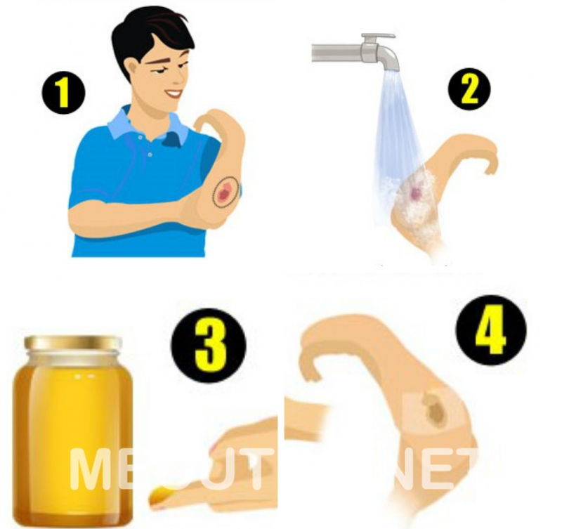 Chữa bỏng nhẹ Chữa bỏng nhẹ