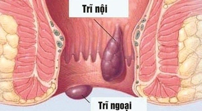 Co nhúm hậu môn mỗi ngày 100 lần