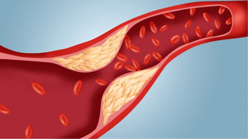 Mức cholesterol trong máu cao
