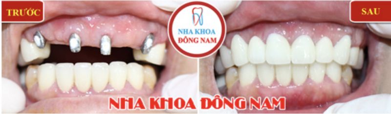 Nha Khoa Đông Nam - địa chỉ uy tín hàng đầu về trồng răng implant