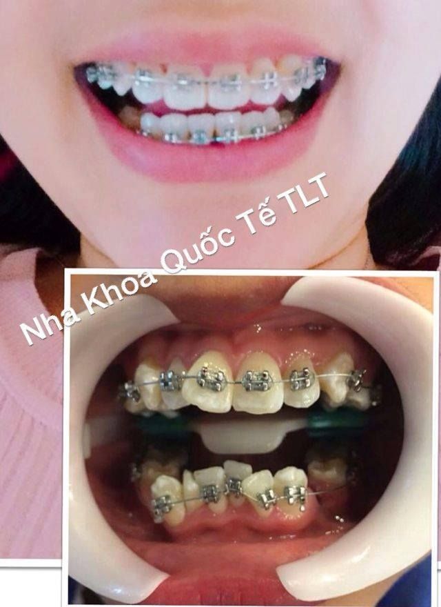 Nha Khoa Quốc Tế TLT