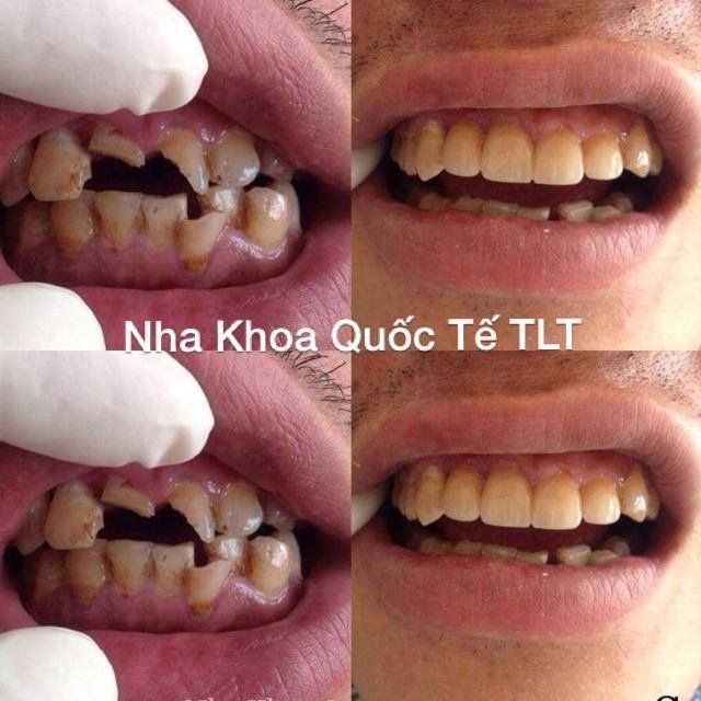 Nha Khoa Quốc Tế TLT