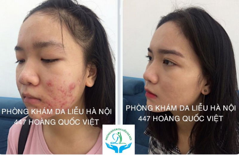 Phòng Khám Da Liễu Trị Mụn Hà Nội