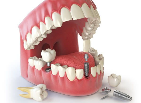 Phương pháp trồng răng Implant