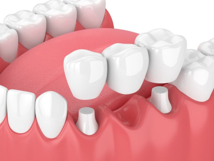 Phương pháp trồng răng bằng cầu răng sứ