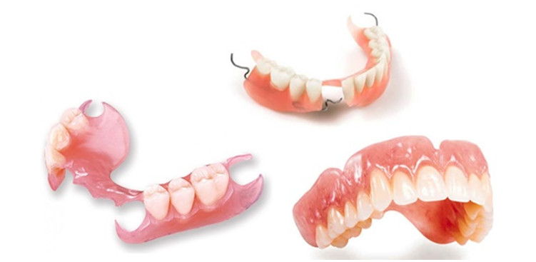 Phương pháp trồng răng bằng hàm giả tháo lắp truyền thống