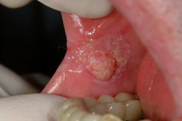 Vết loét hoặc đau trong miệng