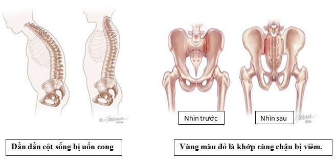 Viêm cột sống dính khớp