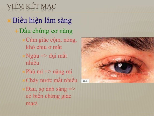 Viêm kết mạc mắt