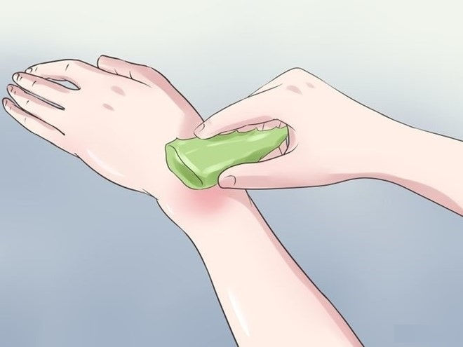Chữa vết bỏng