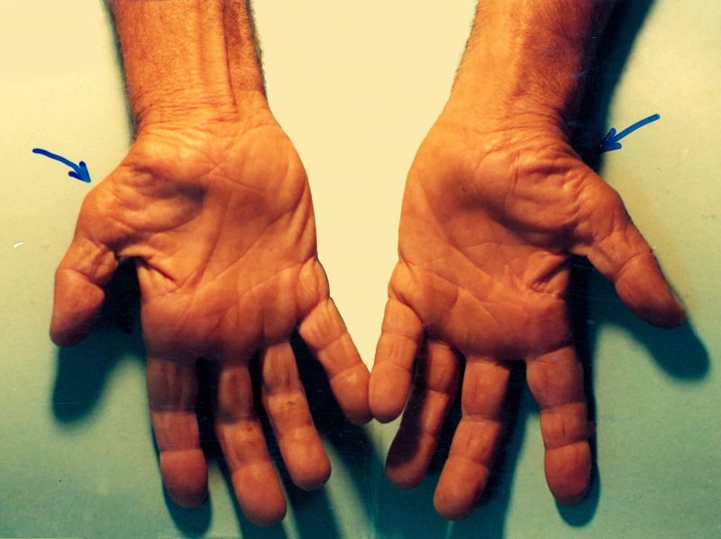 Hội chứng ống cổ tay
