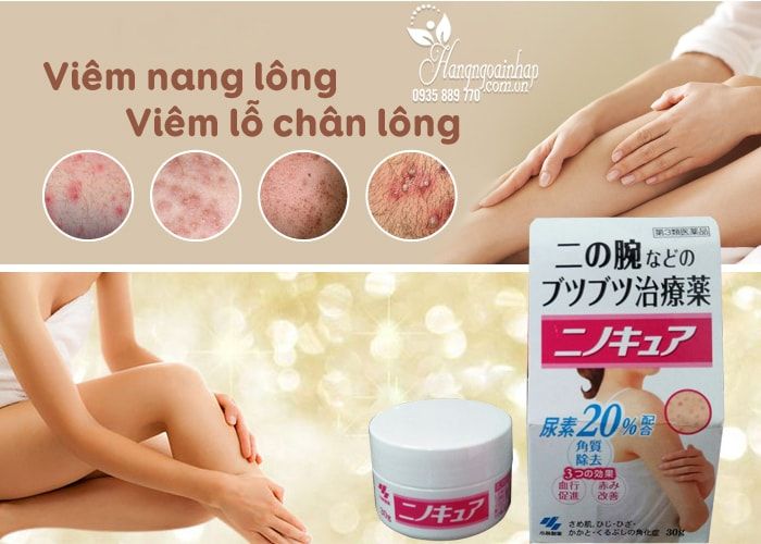 Kem trị viêm nang lông Kobayashi