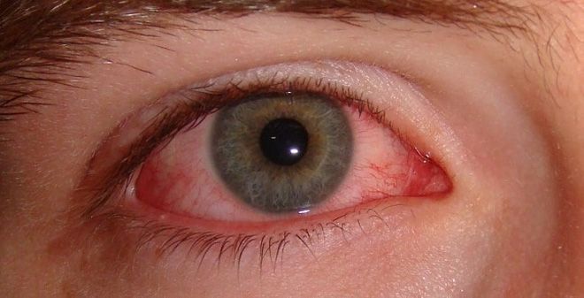 Không dụi mắt để tránh đau mắt đỏ