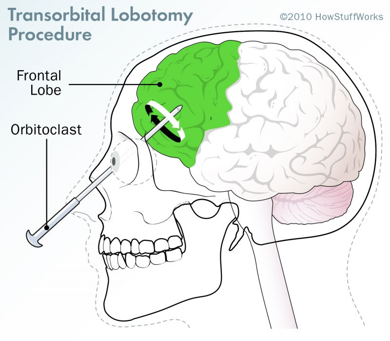 Lobotomy (Phẫu thuật mở thùy não) - Nobel Y học nguy hiểm nhất