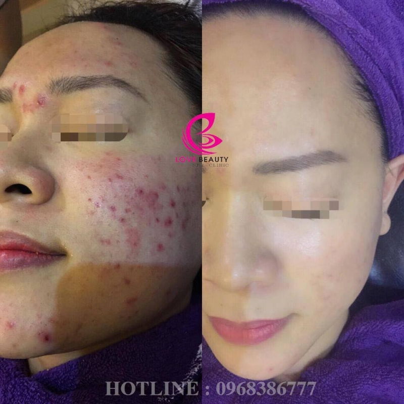 Love Beauty Spa-Quảng Ninh