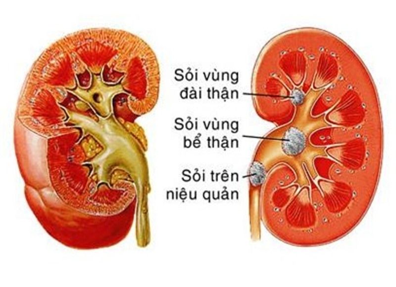 Sỏi thận, sỏi niệu quản