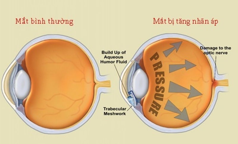 Tăng nhãn áp