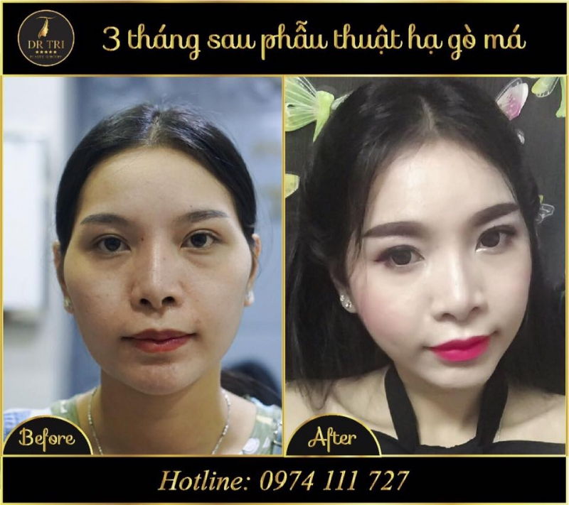 Tiến Sĩ Bác Sĩ Đỗ Thành Trí - Phẫu thuật Thẩm mỹ