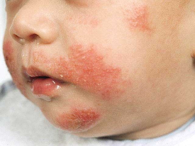 Trẻ mắc các bệnh nhiễm khuẩn