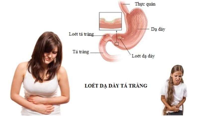 Viêm loét dạ dày, tá tràng