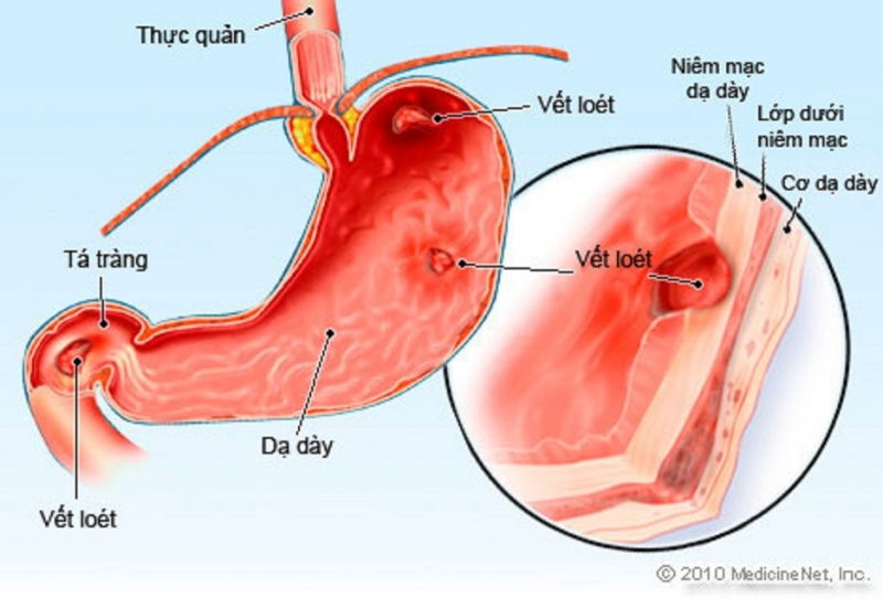 Viêm loét dạ dày