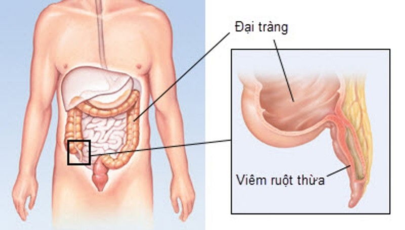 Viêm ruột thừa cấp