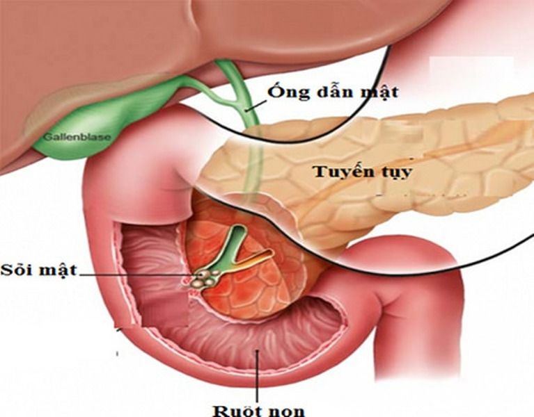 Viêm tụy cấp