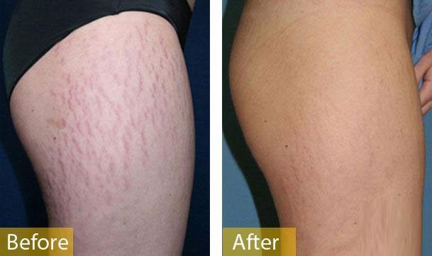 Kem trị rạn da trước và sau sinh Stretch Line