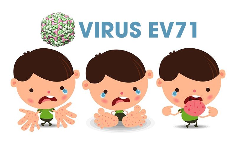 Cảnh giác với bệnh tay chân miệng do chủng virus EV71 gây ra