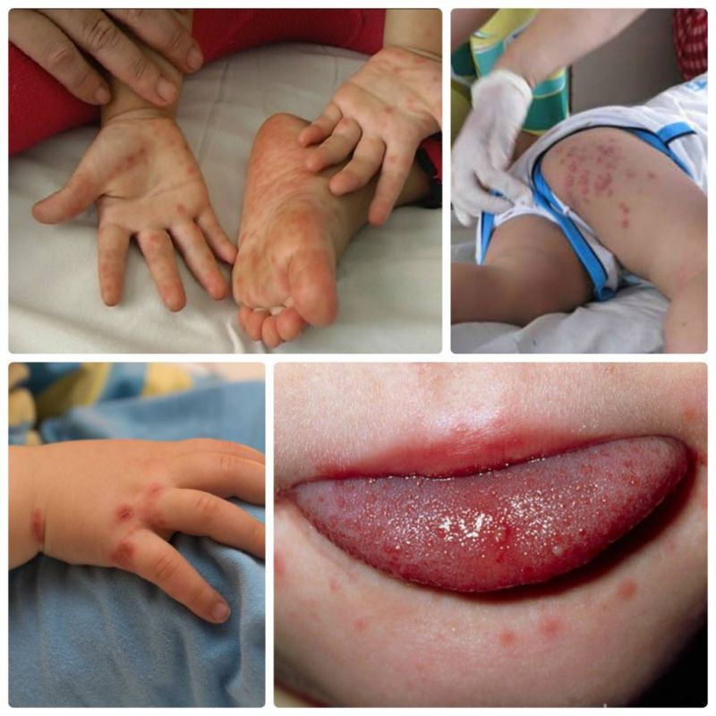 Cảnh giác với bệnh tay chân miệng do chủng virus EV71 gây ra