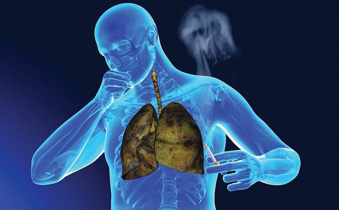 Bệnh ung thư phổi là gì?