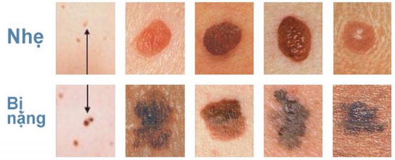 Các giai đoạn của ung thư da