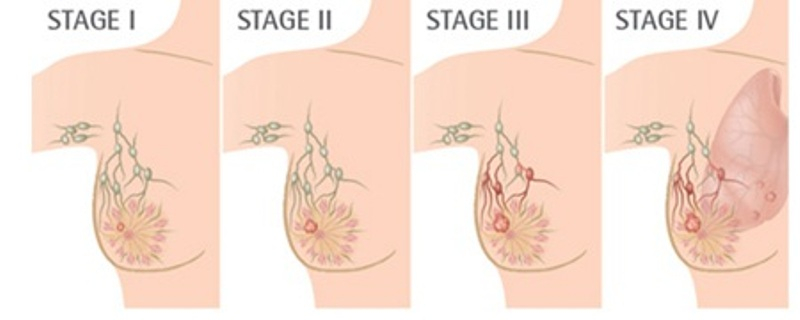 Các giai đoạn phát triển của ung thư vú