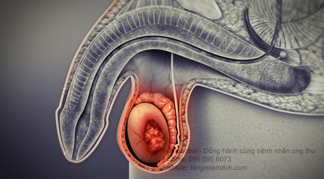 Các giai đoạn tiến triển của ung thư tinh hoàn