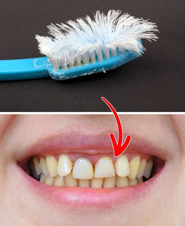 Bạn đang sử dụng bàn chải đánh răng quá cứng