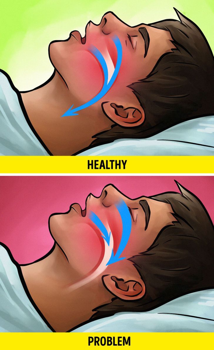 Bạn sở hữu thể mắc chứng ngưng thở khi ngủ (Obstructive Sleep Apnea – OSA)