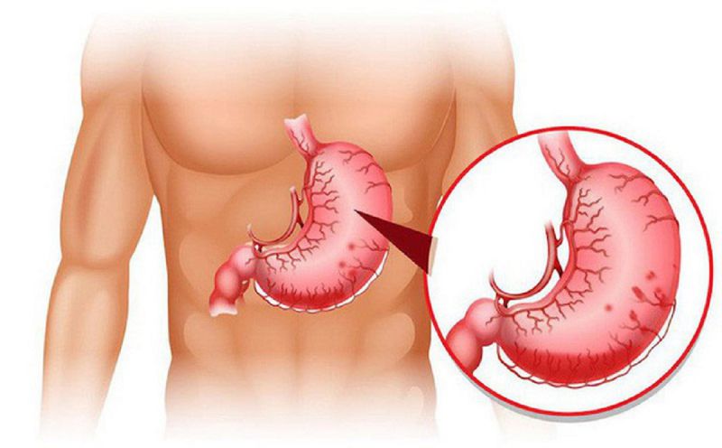 Bệnh dạ dày phì đại (Bệnh Ménétrier) Bệnh dạ dày phì đại (Bệnh Ménétrier)