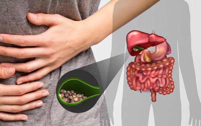 Bệnh sỏi mật (Bệnh Gallstones) Bệnh sỏi mật (Bệnh Gallstones)