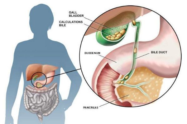Bệnh sỏi mật (Bệnh Gallstones) Bệnh sỏi mật (Bệnh Gallstones)